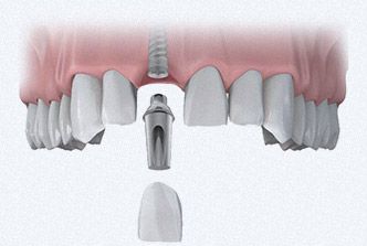 Двухэтапная имплантация